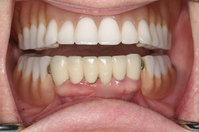 Teeth-In-A-Day: Immediate Implants and Teeth | Teeth-In-A-Day ...