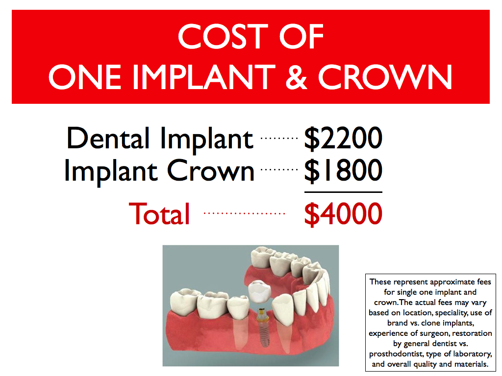 Cost Difference Between Dental Bridge and Dental Implant Cost