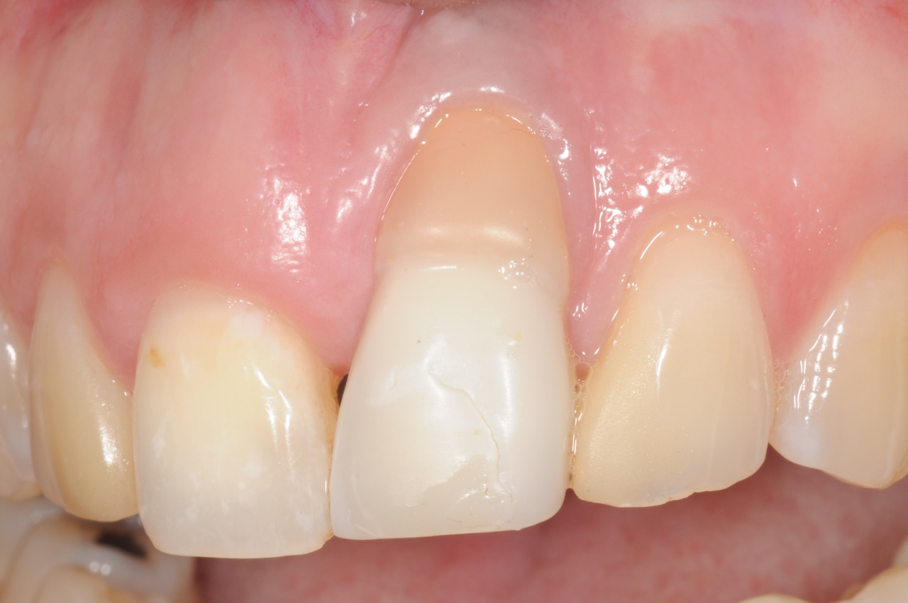 dental implant complications | dental implant complications - Kazemi ...