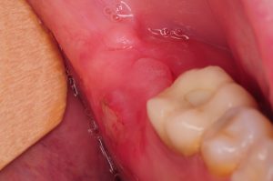 wisdom teeth holes infection