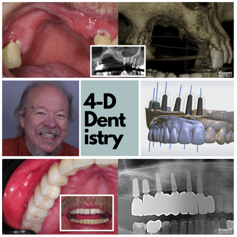 Reconstruction Of Upper Jaw Bone And Multiple Dental Implants For Fixed Bridge Reconstruction