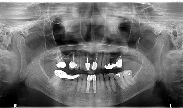 Sinus Lift And Three Dental Implants Sinus Lift And Three Dental 