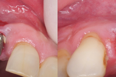 Exploring the Benefits of Non-Invasive Reverse Torque Technique for Dental Implant  Removal, Exploring the Benefits of Non-Invasive Reverse Torque Technique  for Dental Implant Removal - Kazemi Oral Surgery